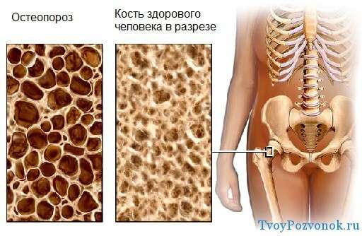 Osteokondroos Brachiaalse uhise 1 kraadi