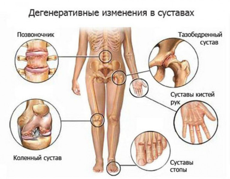 Valutab liigese keskmise sormega Valu liigeste artriidi artritoosis
