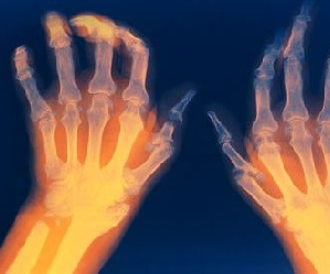 Seene haiguse ravi Folk meditsiin artroosi Otsused sormede
