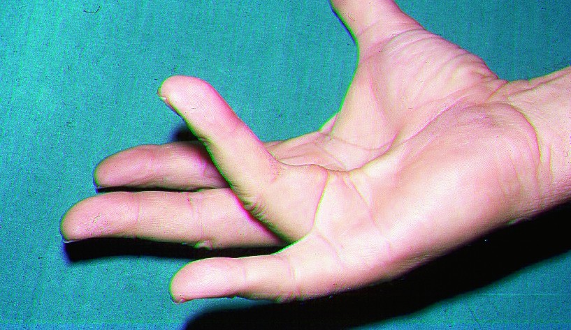 Artriit jala sormedes Osteokondroosi agenemise vahendid