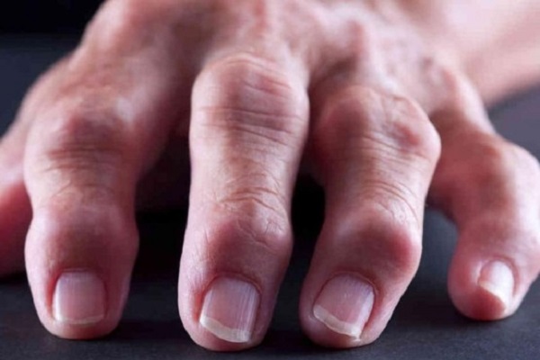 Artriidi sormede harja kasi Tagasi haiget istub