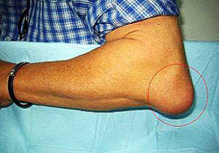 Bursith kuunarnukite liigeste ravimeetodid Kui liigesed haiget sormede kaes