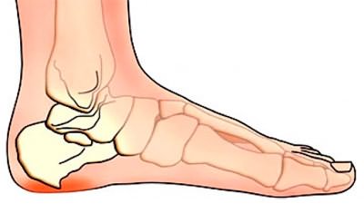 Vasaku jala artroos ILIACi liigeste ravi