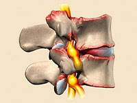 Osteoartriidi perifeersete liigeste ravi