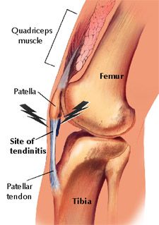 Muscle valu liigesed Pohjus valu jalgade liigeste valu kui kodus ravida