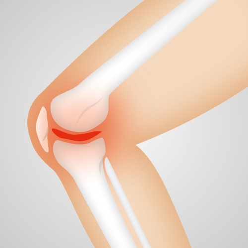 Artrosi jalad ja ravi Agenemine artroosiga