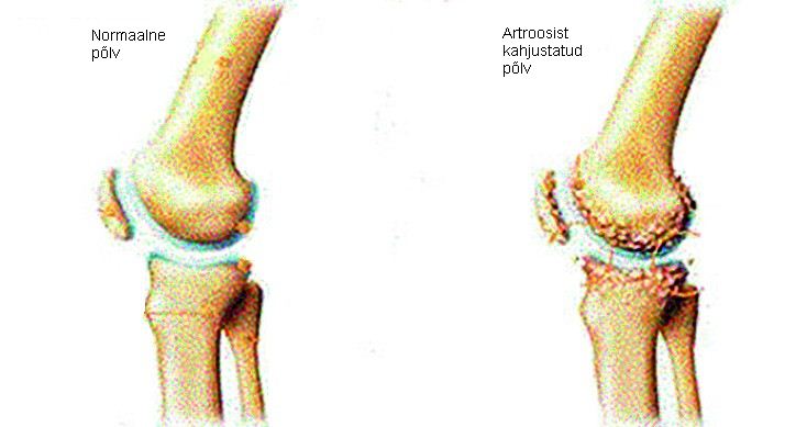 ola liigese artroosi kohta Pohjused arthroosi liigeste