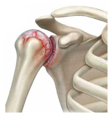 Mida teha ola liigese artroosiga Artriit 2 sormede harja