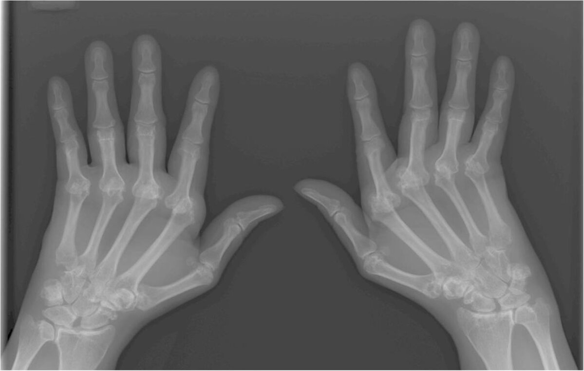 Valu keskmise sorme liigesevalu Artrosi haiguste ja ravimeetodite pohjused