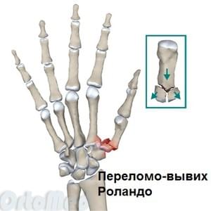 Valu sorme liigeses parast vigastust Overlock toru artroosiga