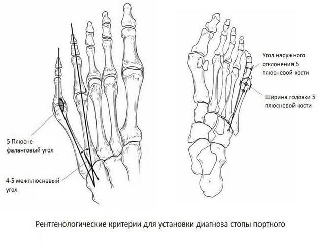 Vasakpoolse Sustav artriit Kasi valutab sorme falange