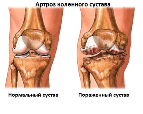 Kuidas ravida valu ja jalgade liigeste valu Artroosi ravi kaespintslitel