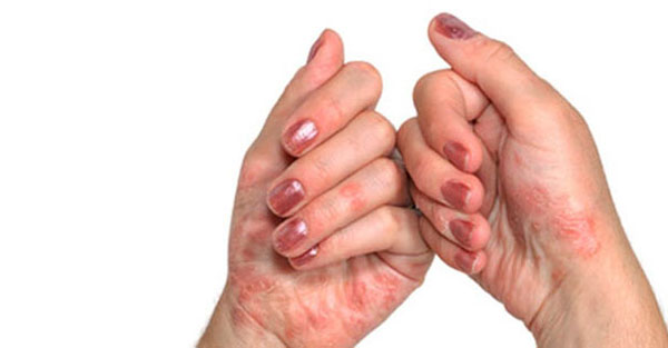 Artriit sorme kate parast vigastusi