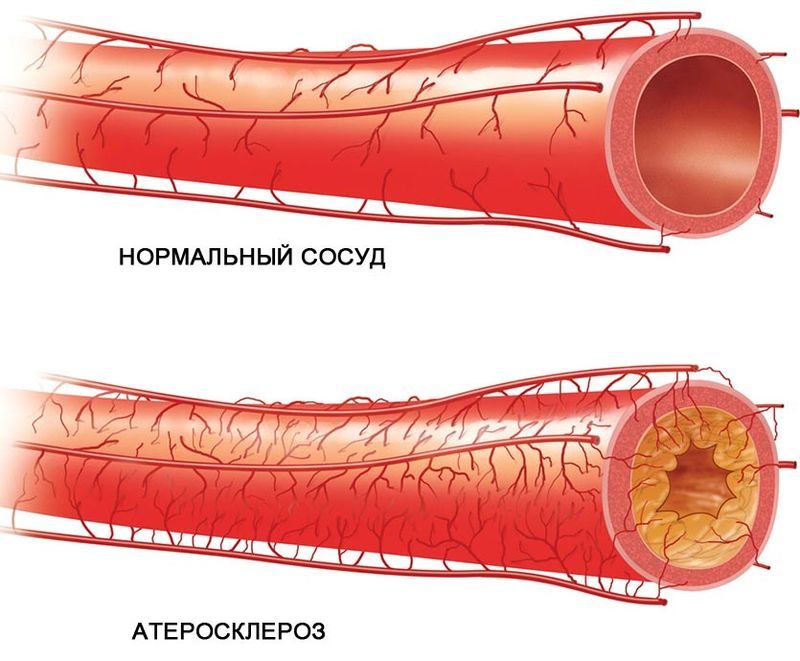 Ateroskleroosi valus liigesed Artroosi ja artriidi nalga ravi