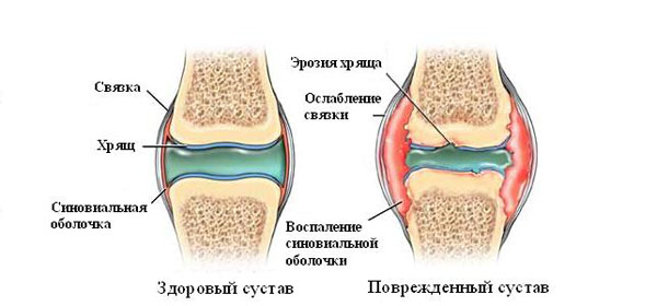 Kuunarnuki liigese artriidi all Thumbsi liigesevalu kaes