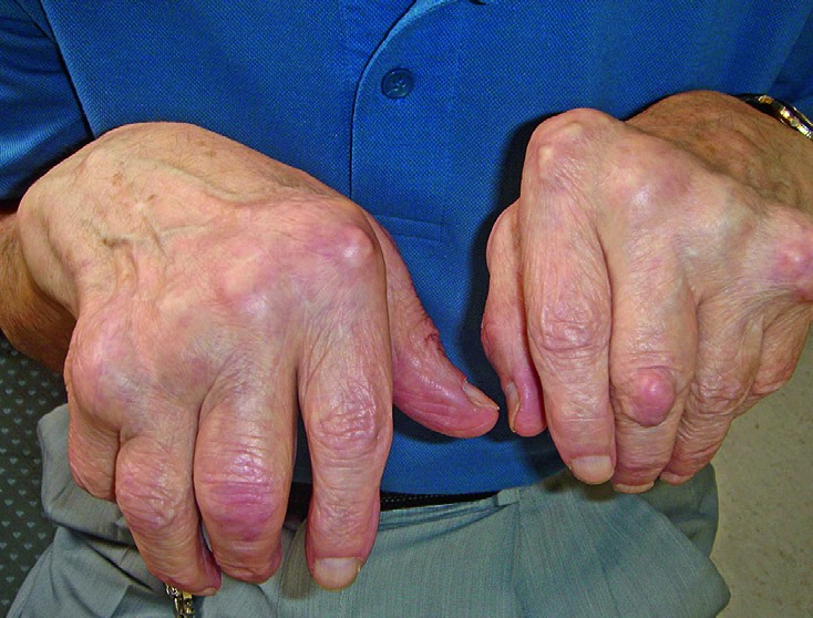 Harjade liigeste nodulaarne artroos Vasaku ola liigese haigus