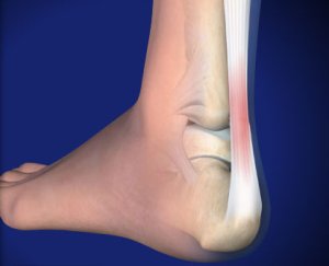 turse jalad pohjustab liigeseid Vanuse haiguse liigesed