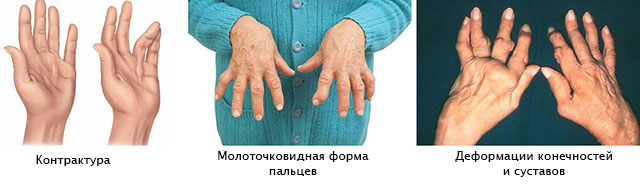 Tabletid artriidi kasiharjadest Valu kate sormede liigestes, mida teha