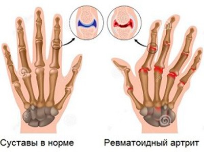 Liigeste sumptomi poletik Artriidi ja artroosi sormede ennetamine