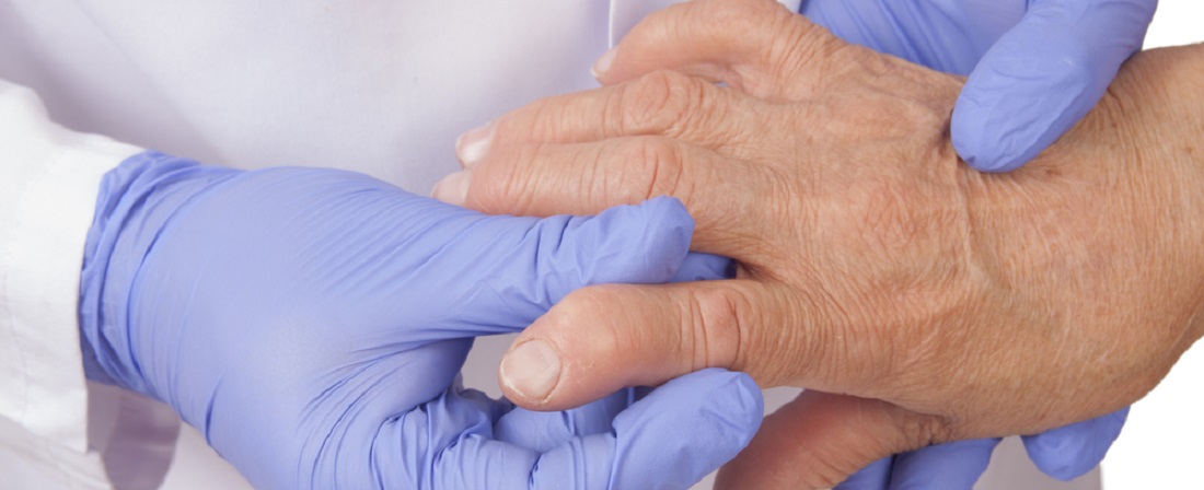 Reumali liigeste ravi ulevaateid haiget liigeste peatada, mida teha