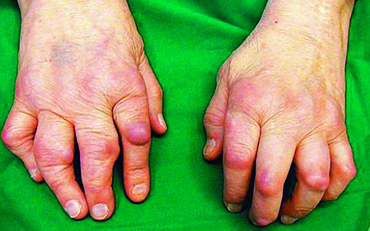 Valu liigeste artriidi artritoosis