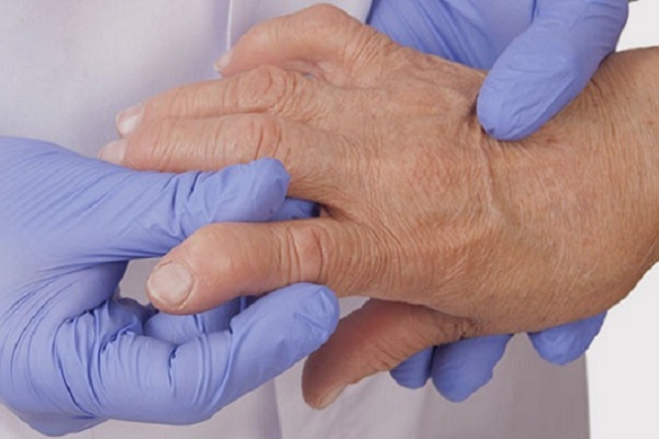 Artriit sorme kate parast vigastusi