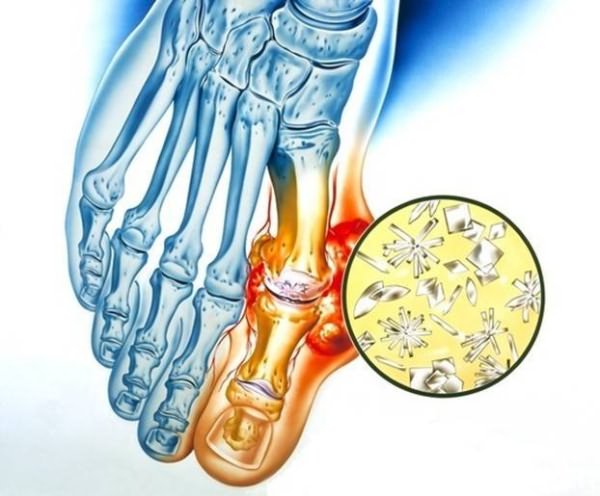 Koonused ravi liigestele Eemaldage valu jala jalgsi