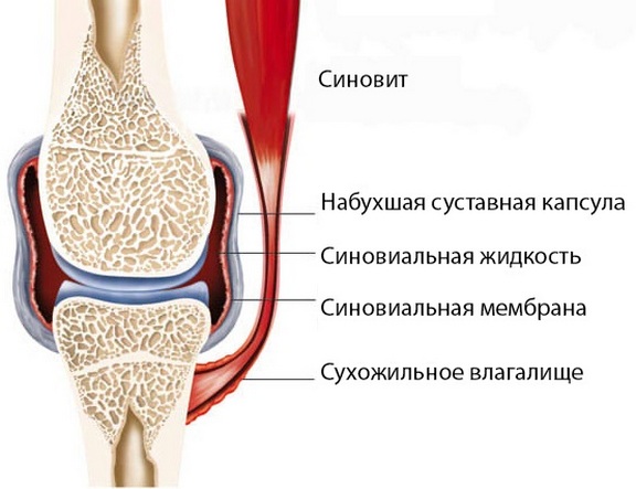 Nao sailitamise artriidi artroos