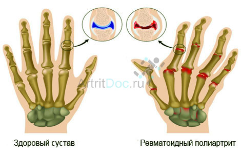 Haige sorme liigesed Meditsiinilise sapi liigeste ravis