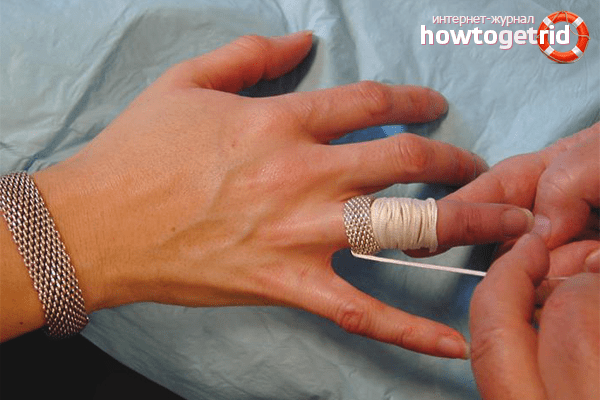 Kuidas eemaldada turse sormest valu liigestes parast tootlemist