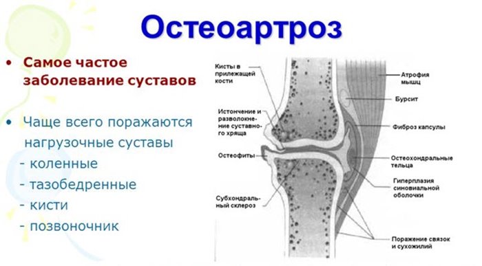 Kuidas lihtsustada valu liigestes kus Venerealsed haigused valulikud liigesed