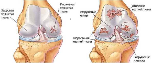 Ravi arthrome jalg