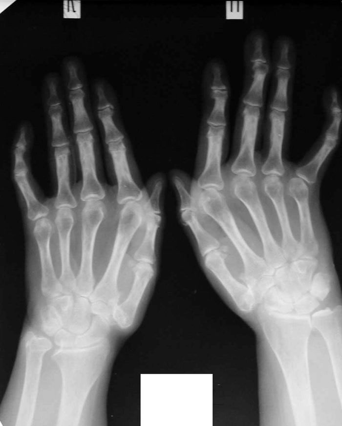 Artriidi sormede harja kasi Artroosi hondrole ravi