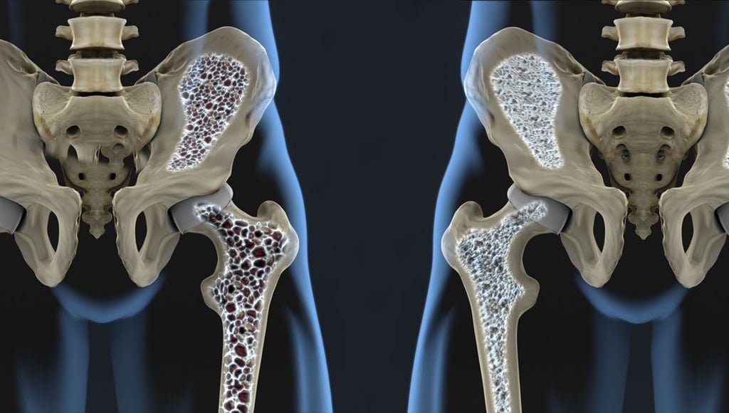 Artroosi liigeste poletik Milline efektiivne salv osteokondroosis