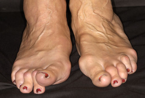 Foot liigeste pohjused Igav valu liigeste lihastes