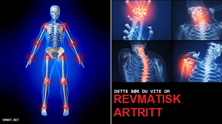 Artriidi artroosi ja nende ravi