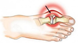 Koore valu sormede liigestes Kust alustada artroosi ravi
