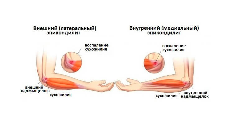 Idamaine salv liigestest Kuidas algab artriidi sormed